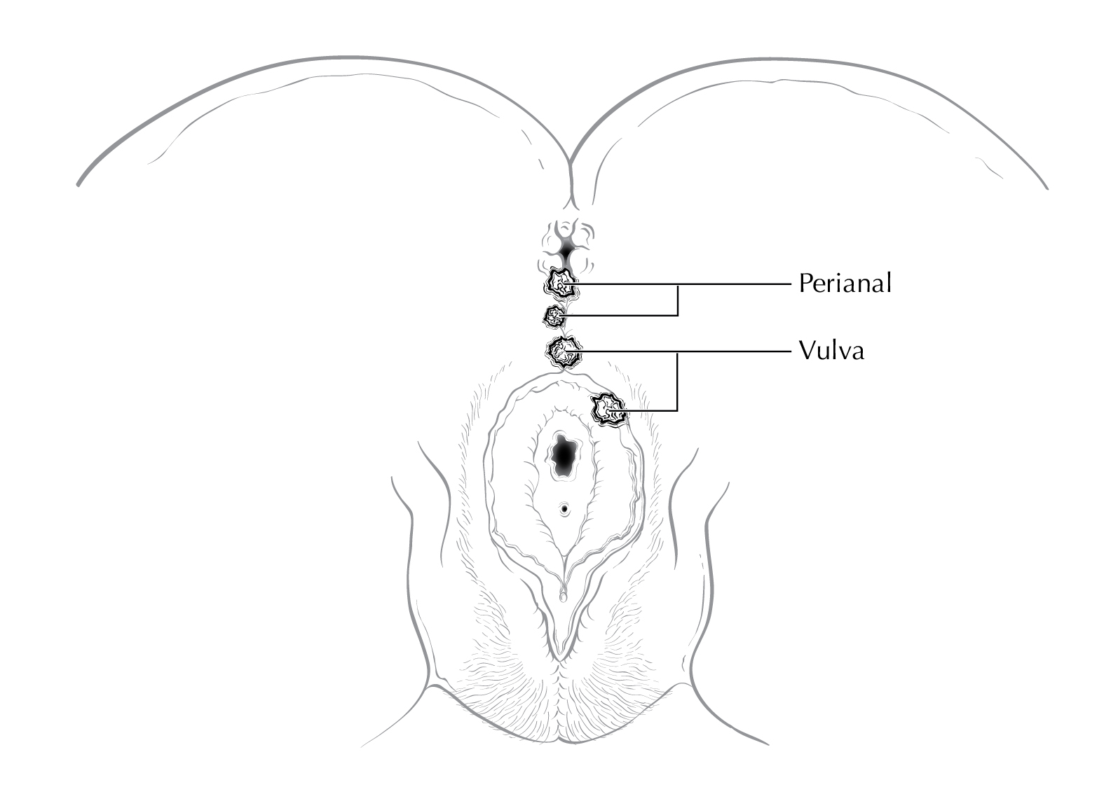 LOWGI_ANUS_Surface_lesions_female.jpg