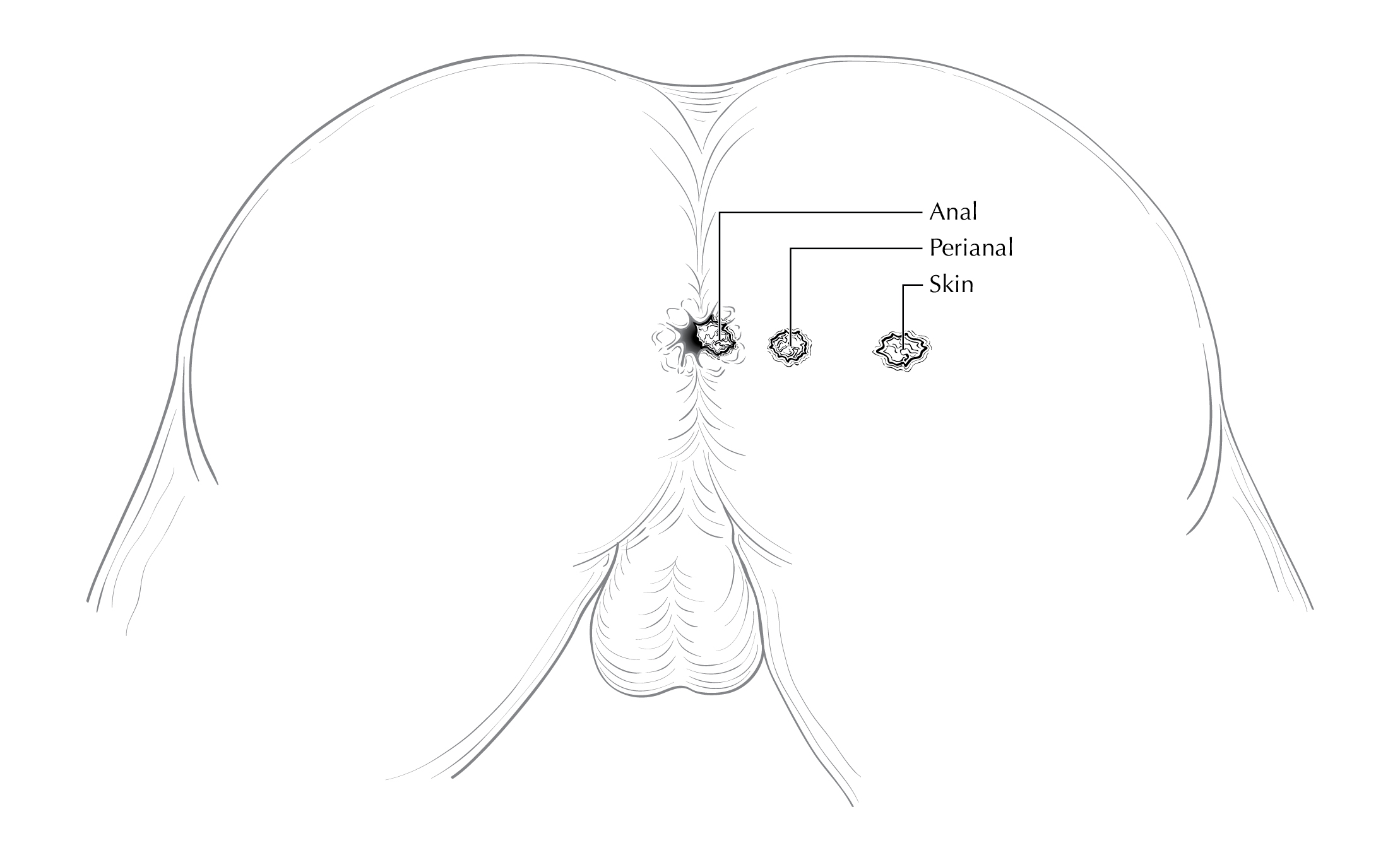 LOWGI_ANUS_Surface_lesions_male.jpg