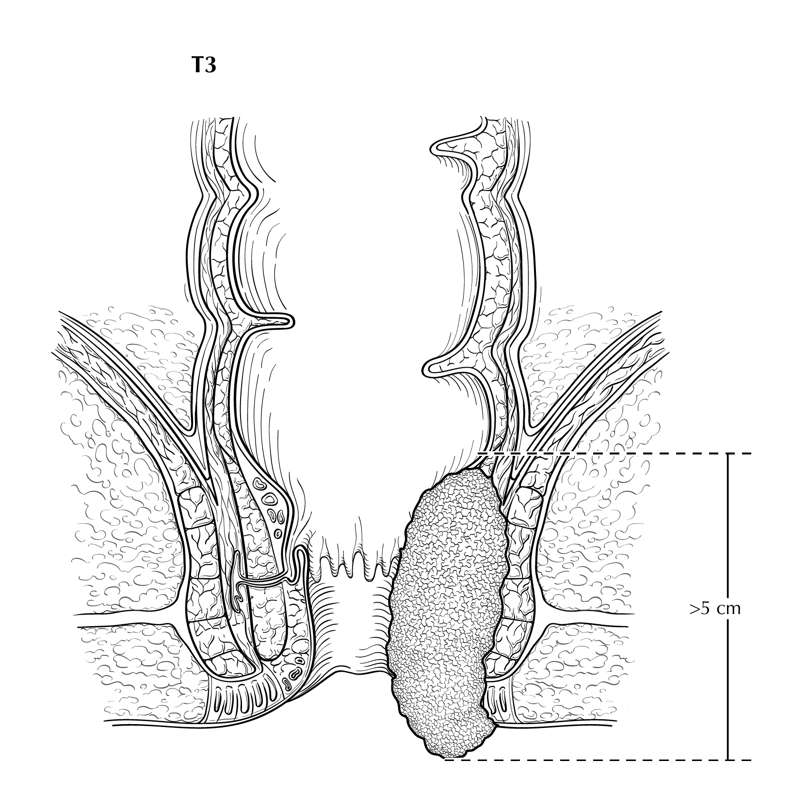 LOWGI_ANUS_T3.jpg