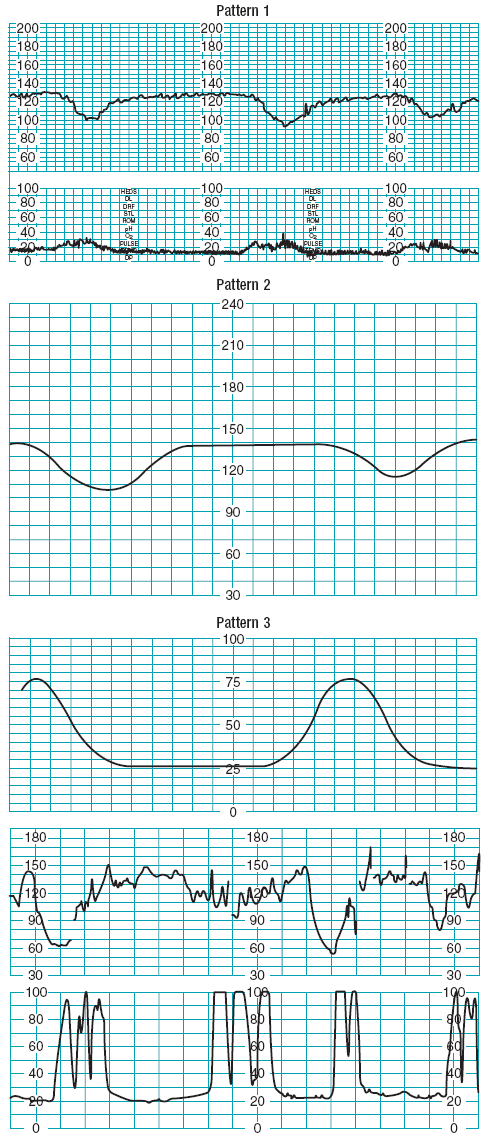Pattern1-2-3